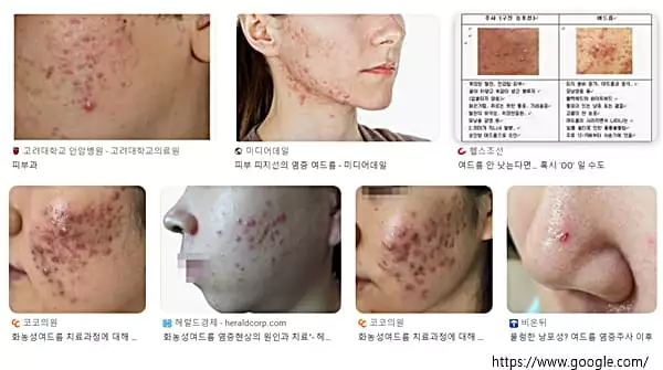여드름피부과 치료 가격 및 효과 추천